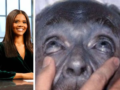 Candace Owens pushes ‘health supplement’ that can turn people’s skin permanently blue