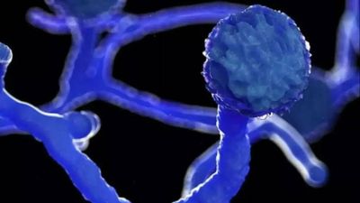 Mumbai: Mucormycosis case surfaces again, now due to uncontrolled diabetes