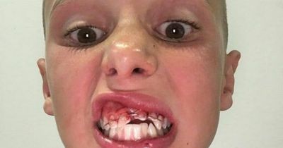 Boy left with teeth in his nose after gruesome accident on hotel water slide