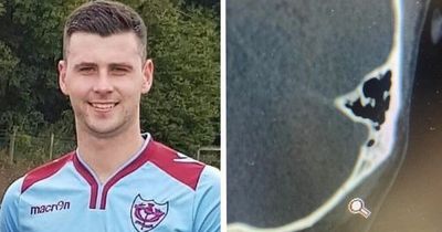 Scots footballer opens up over horror fractured skull and relief at return to action