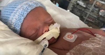 Tiny baby died after being born with rare birthmark covering half his liver