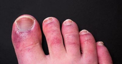 Omicron symptoms on your skin including hives, prickly heat and 'Covid toes'