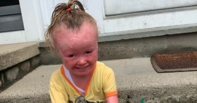 Girl, 4, forced to eat 2,100 calories a day due to rare condition that makes skin grow