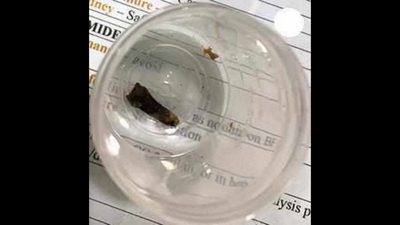 ‘Cancer lump’ turns out to be a clove stuck in lung