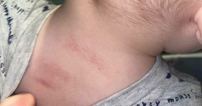 Mum distraught after son left with head cut and bruises after first day at nursery