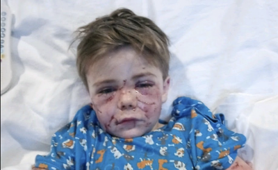 ‘The dog used me as a chew toy, Mummy’: Seven-year-old from Texas left needing surgery after dog attack