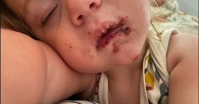 Mum shares photos of her child riddled with painful sores in warning about kissing kids