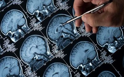International Epilepsy Day: Neuro specialists discuss causes, treatment options