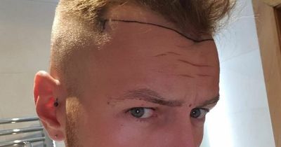 Bloke whose hair loss left him 'looking like Dracula' splashes out £5k on transplant so he can style it 'like David Beckham'