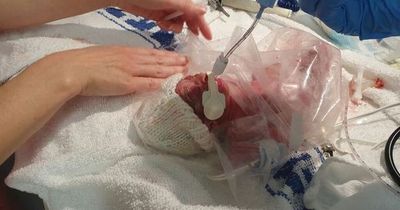 Baby born so tiny she was put in sandwich bag to keep warm