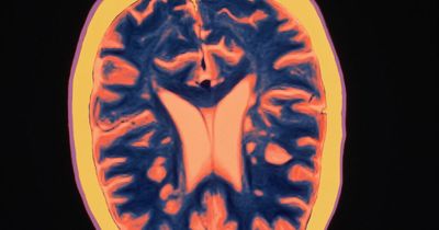 New treatment for Multiple Sclerosis discovered by Scottish scientists