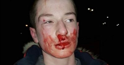 Boy brutally attacked by teen gang in Dublin thought he was 'going to die'