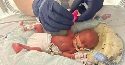 Britain's smallest baby born in Glasgow hospital defies odds and opens eyes