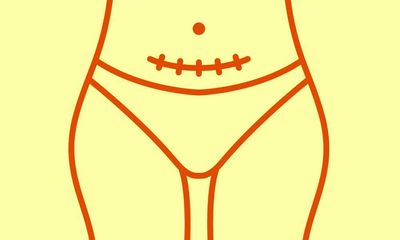 Caesareans or vaginal births: should mothers or medics have the final say?