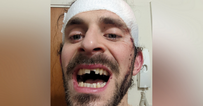 Man's tooth knocked out in horrifying attack - but he's unable to book dentist appointment