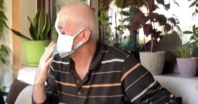 Man's nose melts off leaving massive hole in his face after pimple turned cancerous