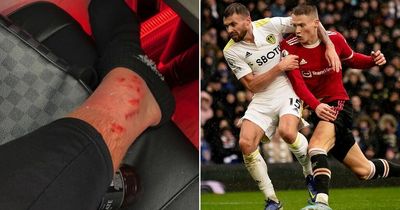 Scott McTominay shows off gruesome battle scars from Man Utd's win over Leeds