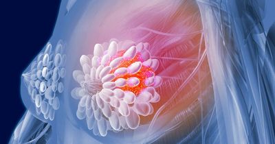 'Artificial intelligence may find aggressive breast cancer cases tests fail to spot'