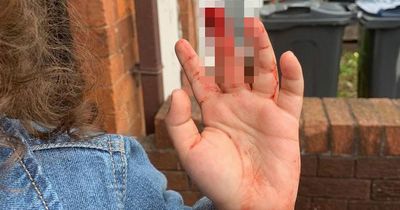 Girl, 3, left needing plastic surgery after slicing finger to bone in horror KFC fall