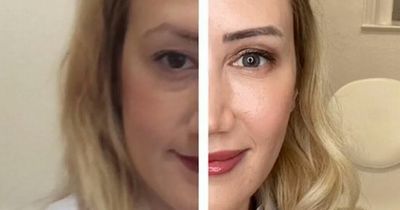 Woman has 'full-face rejuvenation' to knock 10 years off - and is unrecognisable