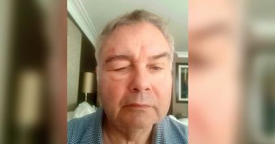 Eamonn Holmes' 'horrendous' shingles battle as he can't look at son's wedding photos