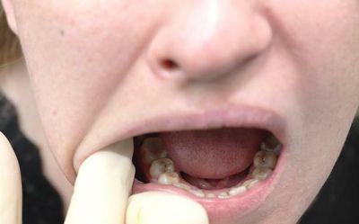The role Fusobacterium plays in oral cancer patients in India