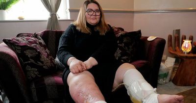 Mum fears she will die after mystery insect bite causes her legs to balloon