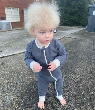 US boy with uncombable hair syndrome becomes Instagram hit