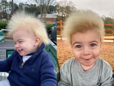 A mother learned her son had a rare genetic condition after a stranger sent her a DM about his hair