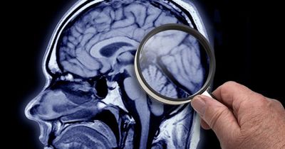 Does Covid cause brain damage - even mild cases can cause shrinkage according to new study