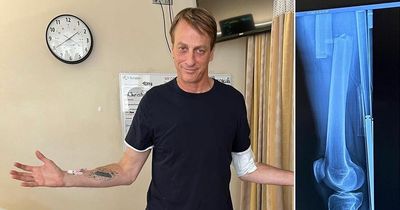 Skateboard legend Tony Hawk snaps femur in horrific leg break and says he may never recover