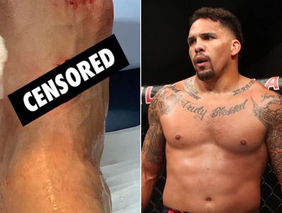 UFC middleweight Eryk Anders shares graphic photo after chainsawing foot