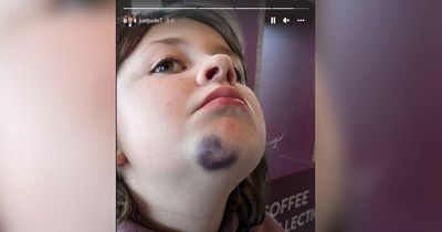 ITV Coronation Street Jude Riordan 'sore' after nasty injury