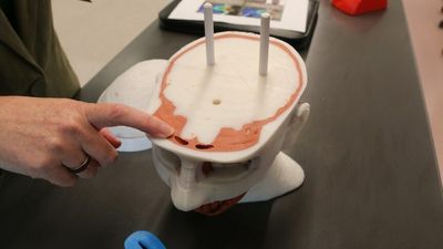 Brisbane bio-tech lab creates 'revolutionary' 3D-printed body parts to treat cancer patients