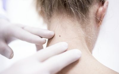 Seven out of ten Australians will need a skin cancer surgically removed
