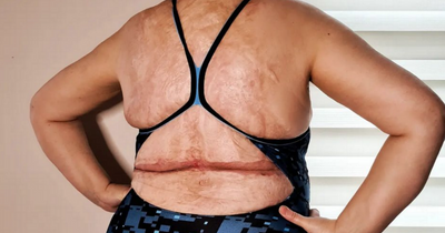 Woman who suffered fourth-degree burns now models bikinis and walks at London Fashion Week