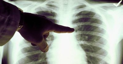 The number of people dying from cancer fell rapidly in the pandemic but experts don't fully understand why
