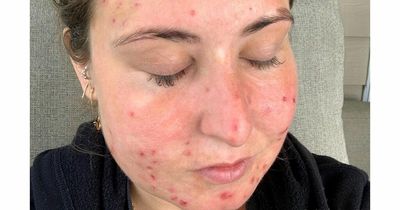 'I can't stop picking at my own skin - my infected leg was almost cut off'