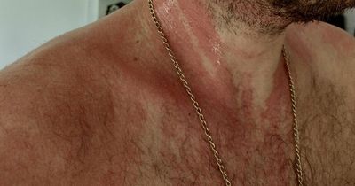 Hairdresser suffers pain 'like acid on skin' after using baby shampoo