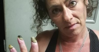 Woman's fingers turn black and are close to falling off after years of smoking