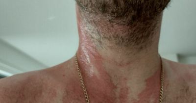 Hairdresser in agony suffering severe allergic reaction after using baby shampoo