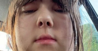 Teenager 'nearly died' after being told huge lump on eye was likely a symptom of Covid