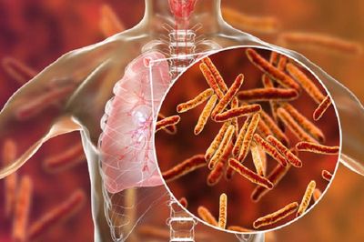 Health and Fitness: Study finds tuberculosis can induce premature cellular ageing