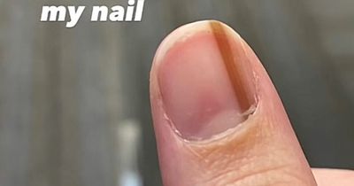 Woman shocked as 'seemingly harmless' symptom on fingernail turned out to be cancer