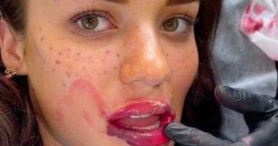 DIY freckles TikTok beauty trend inspired by Meghan Markle leaves women's faces scarred