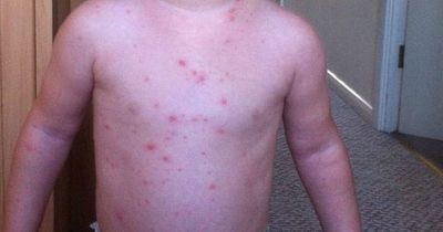 How easy is it to catch chickenpox as cases spread in UK - what you need to know