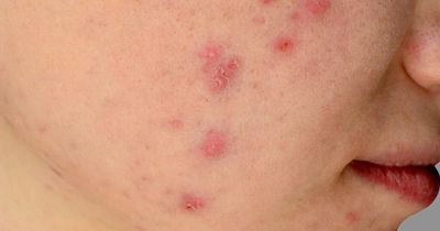 Early chickenpox signs and symptoms to look out for in children as UK cases rise