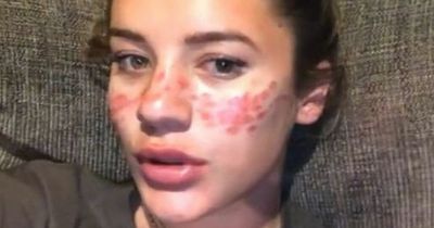 Warning as TikTokers left with scars after tattooing freckles on their face to 'look like Meghan Markle'