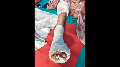 Dealt a bad hand by fate, 19-year-old DU student fears losing a foot to apathy