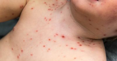 Chicken Pox season is underway - symptoms, how to treat and how long it lasts